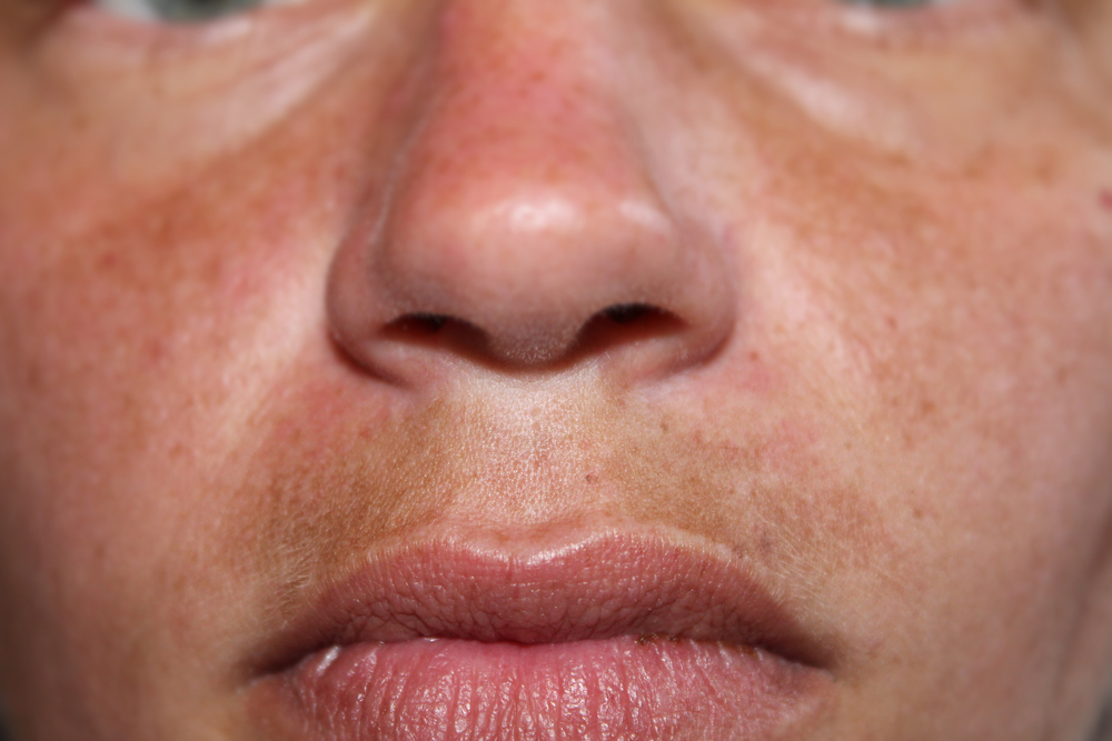 Melasma Mustache How to Reverse Dark Upper Lip Este